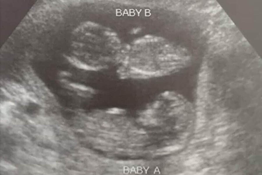 Sonogram of Tennessee twins who survived a chemical abortion at Planned Parenthood just a few weeks ago