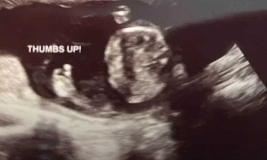 An 18-week-old unborn baby gives a thumbs-up during an ultrasound