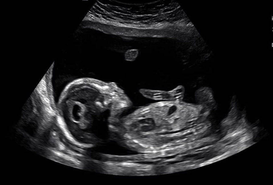 Baby Zion's 20-week ultrasound