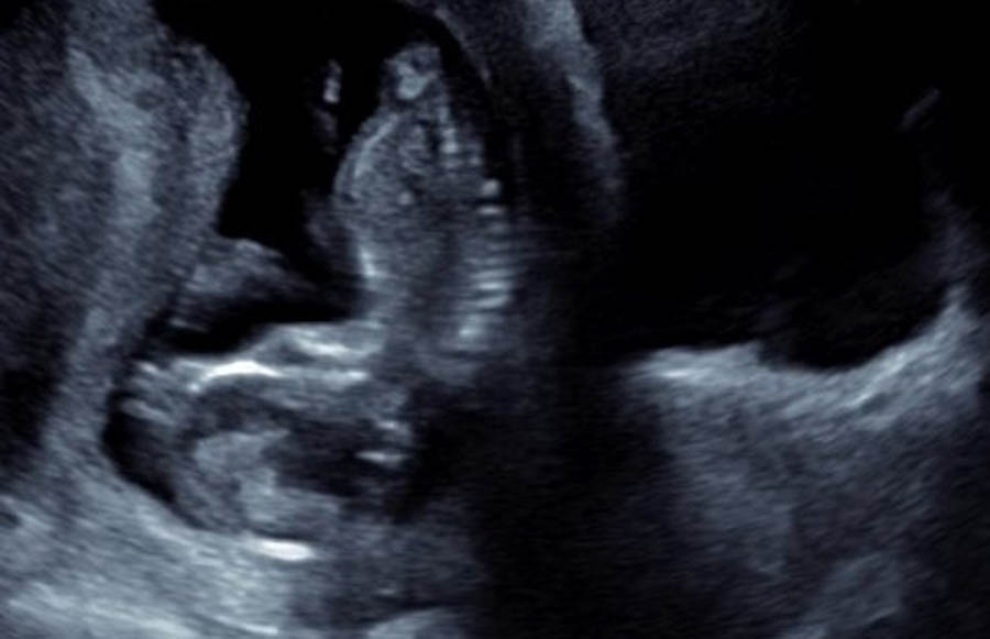 "Deanna's" ultrasound