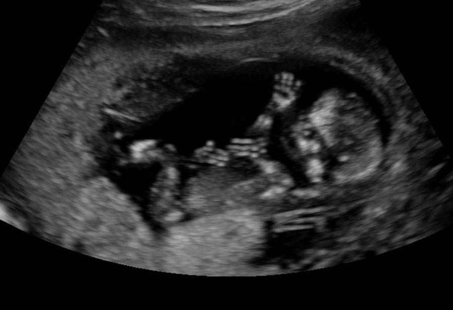 True Care ultrasound 14 weeks