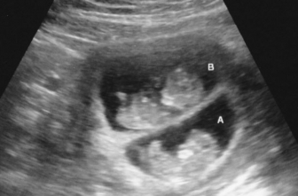Twin babies in the womb captured via ultrasound