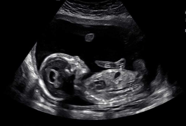 Baby Zion&#039;s 20-week ultrasound