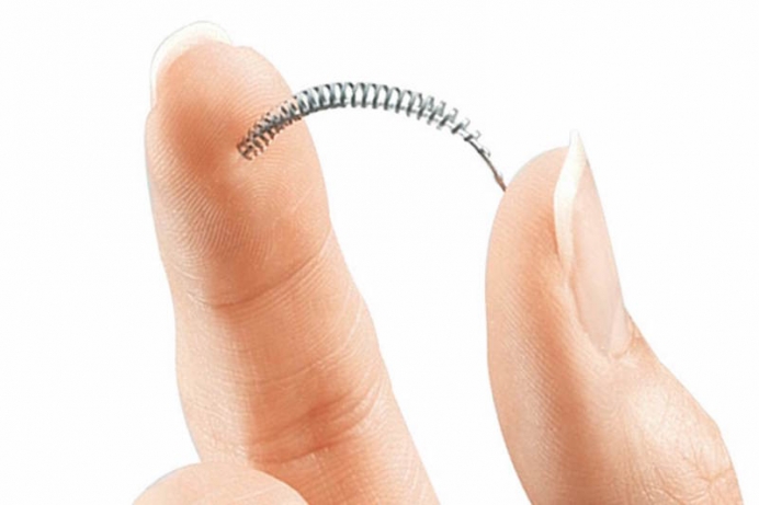 What You Need to Know About Essure Litigation