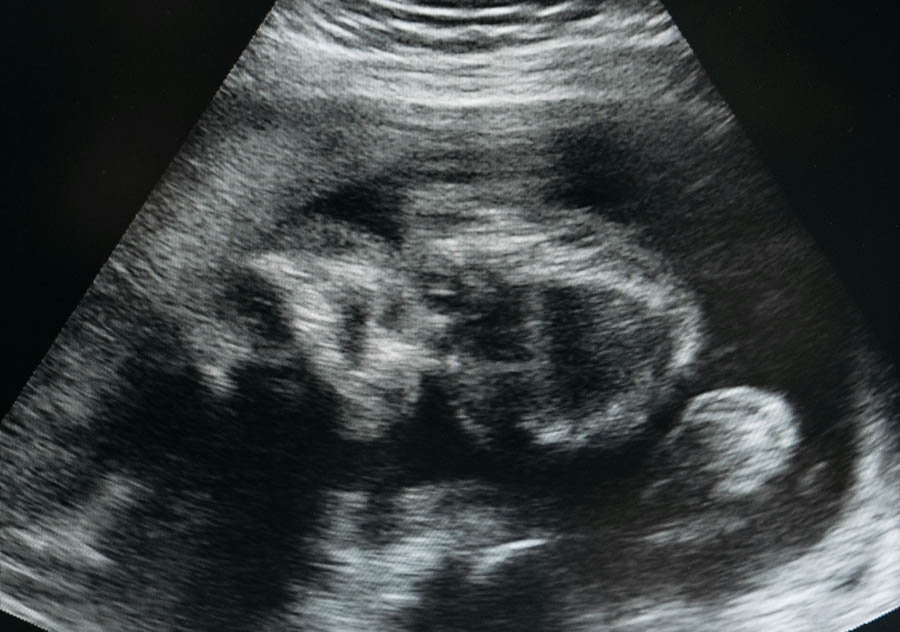 Though the left may try, the impact of an ultrasound cannot be denied